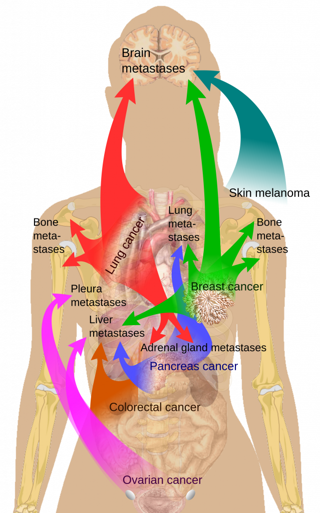 أعراض و مضاعفات سرطان الرئة