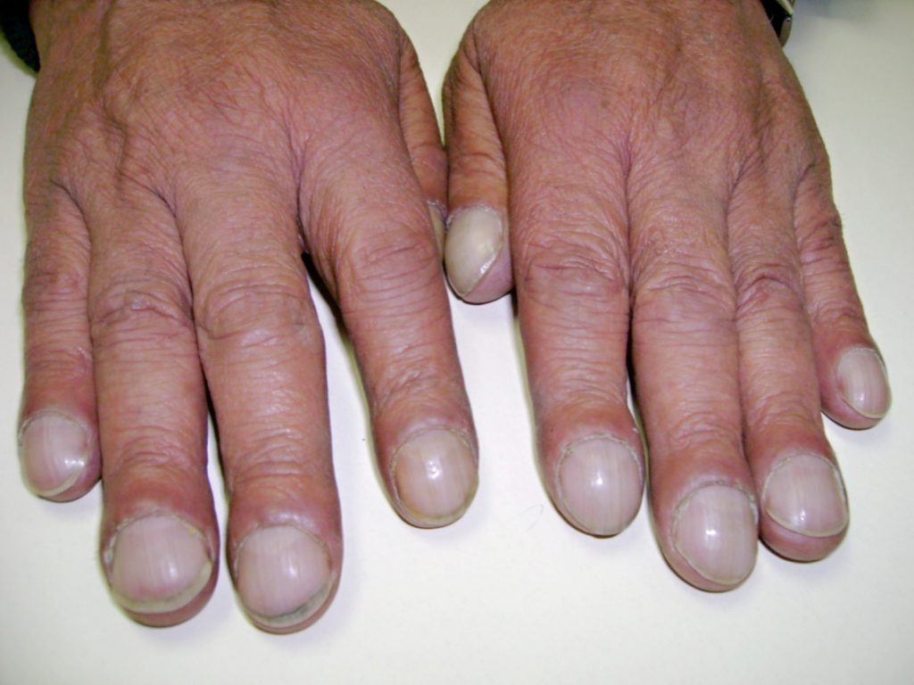 تضخم أطراف أصابع اليدين أو القدمين نتيجة اضطرابات الرئة