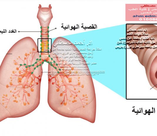 اورام القصبة الهوائية