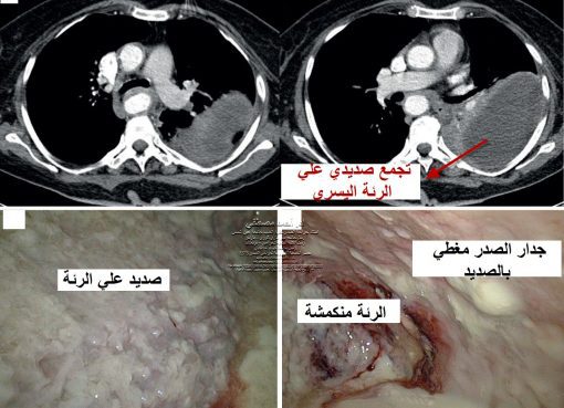 تقشير الغشاء البلوري