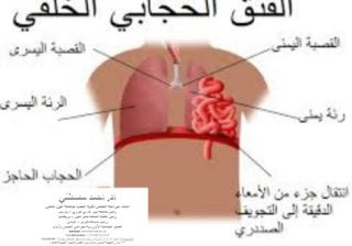 فتق الحجاب الحاجز