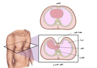 التقعر الصدري