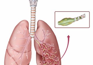 تمدد القصبات الهوائية